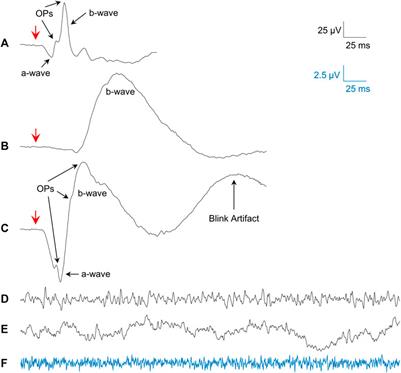 Resting state electroretinography: An innovative approach to intrinsic retinal function monitoring